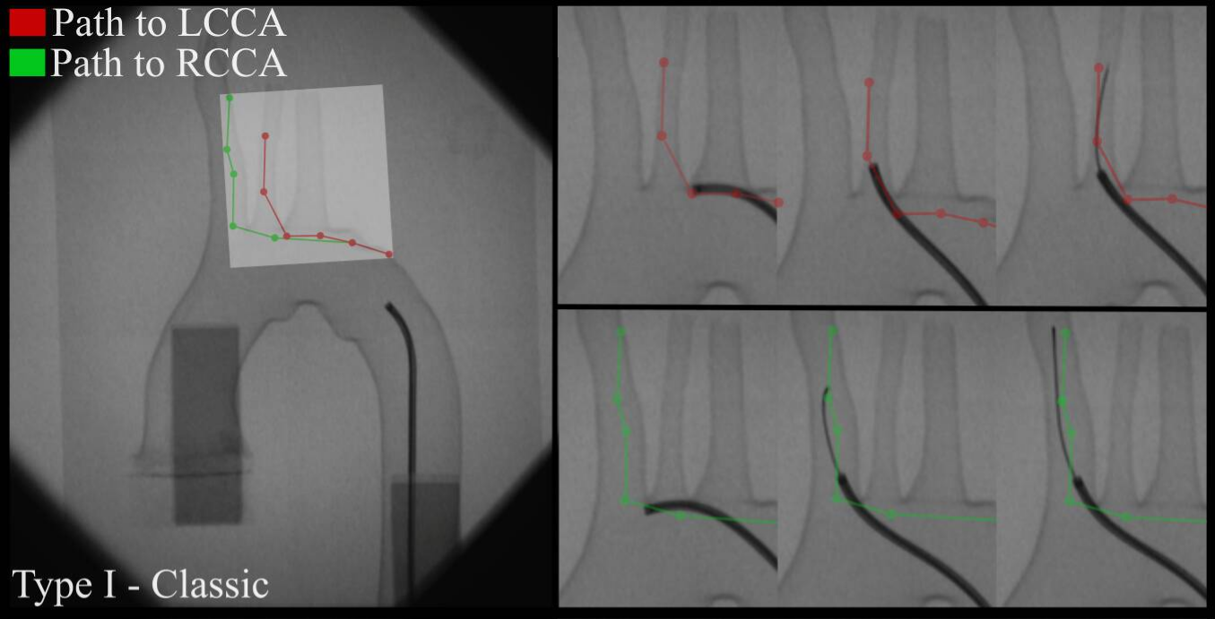 Contact-aware Path Planning for Autonomous Neuroendovascular Navigation